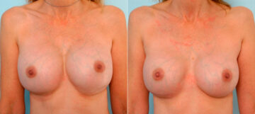 Breast Revision with Strattice before and after photos in Houston, TX, Patient 27159