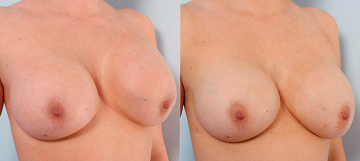 Breast Revision with Strattice before and after photos in Houston, TX, Patient 27180