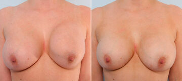 Breast Revision with Strattice before and after photos in Houston, TX, Patient 27180