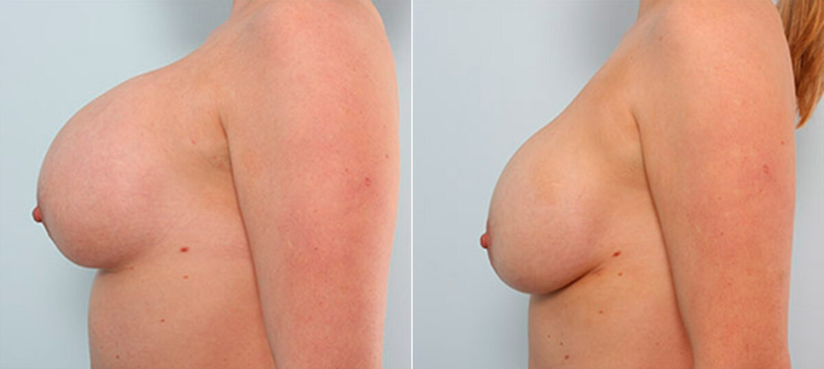 Breast Revision with Strattice before and after photos in Houston, TX, Patient 27180