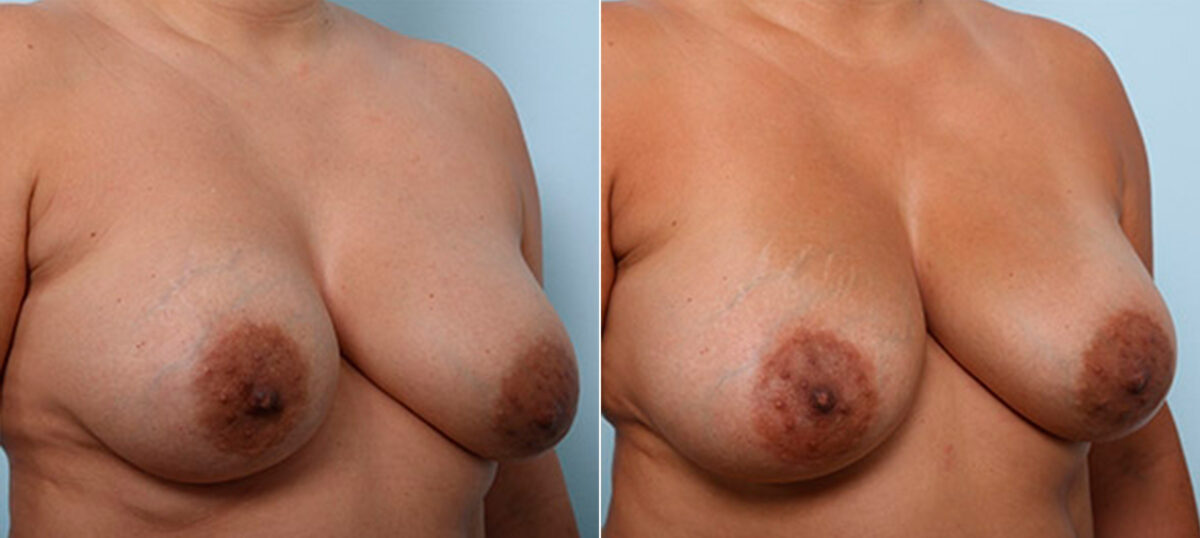 Breast Revision with Strattice before and after photos in Houston, TX, Patient 27191