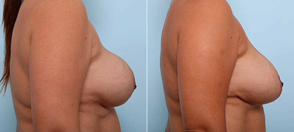 Breast Revision with Strattice before and after photos in Houston, TX, Patient 27191