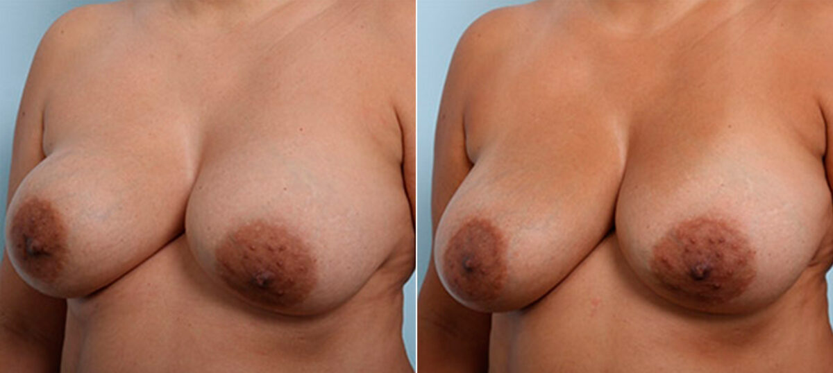 Breast Revision with Strattice before and after photos in Houston, TX, Patient 27191
