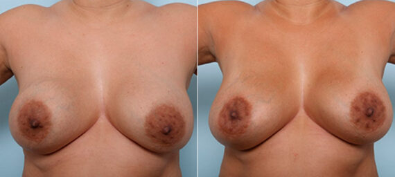 Breast Revision with Strattice before and after photos in Houston, TX, Patient 27191