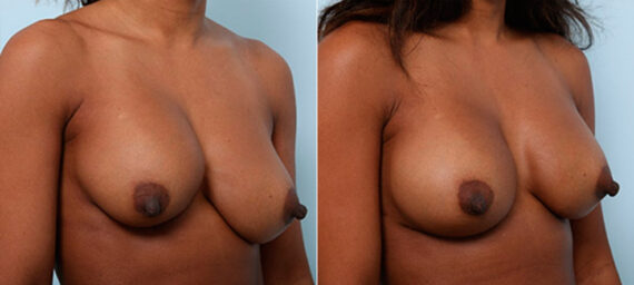 Breast Revision with Strattice before and after photos in Houston, TX, Patient 27202