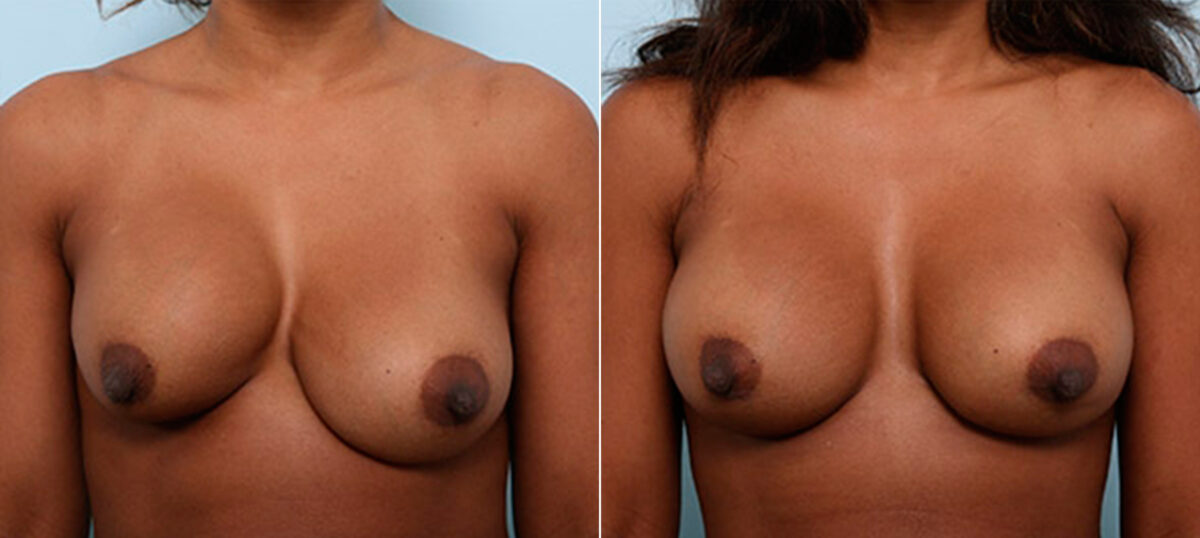Breast Revision with Strattice before and after photos in Houston, TX, Patient 27202