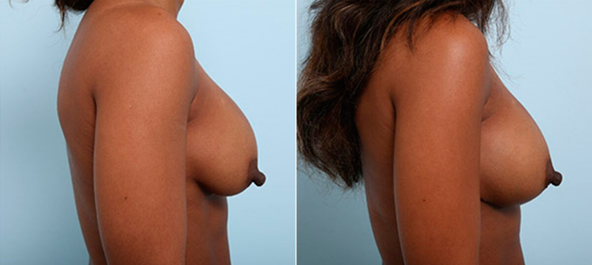 Breast Revision with Strattice before and after photos in Houston, TX, Patient 27202