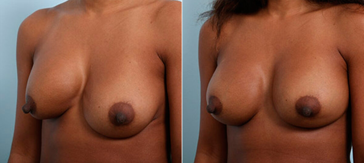 Breast Revision with Strattice before and after photos in Houston, TX, Patient 27202