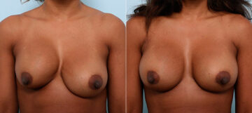Breast Revision with Strattice before and after photos in Houston, TX, Patient 27202