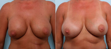 Breast Revision with Strattice Before and After Photos in Houston, TX, Patient 27213