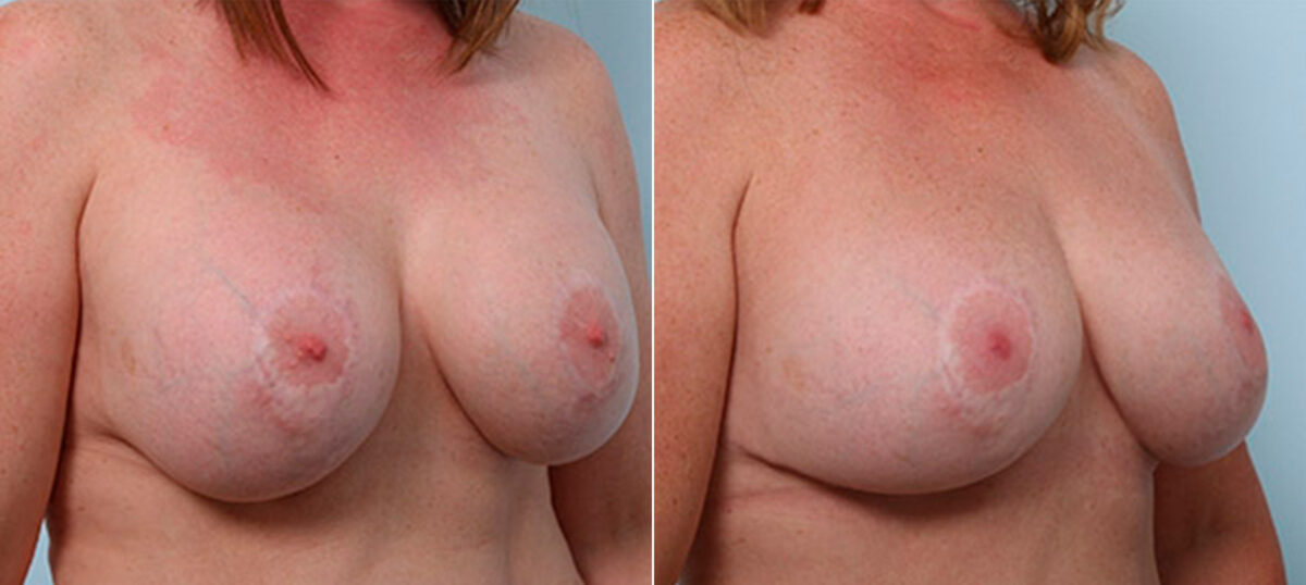 Breast Revision with Strattice before and after photos in Houston, TX, Patient 27224