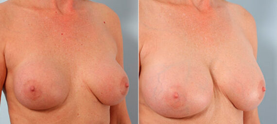 Breast Revision with Strattice before and after photos in Houston, TX, Patient 27257