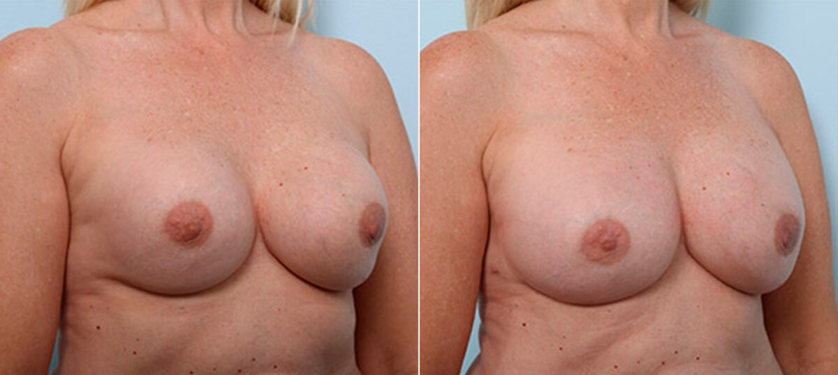 Breast Revision with Strattice before and after photos in Houston, TX, Patient 27268
