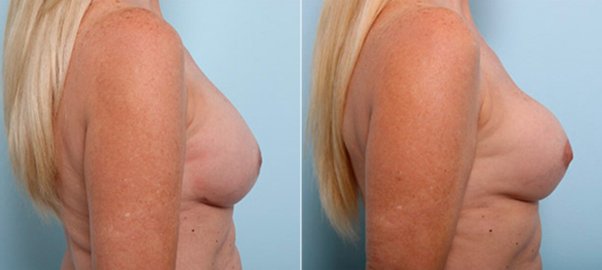 Breast Revision with Strattice before and after photos in Houston, TX, Patient 27268
