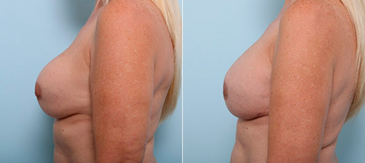 Breast Revision with Strattice before and after photos in Houston, TX, Patient 27268