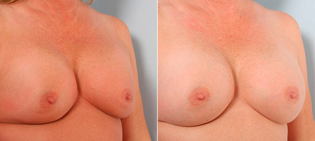 Breast Revision with Strattice before and after photos in Houston, TX, Patient 27279