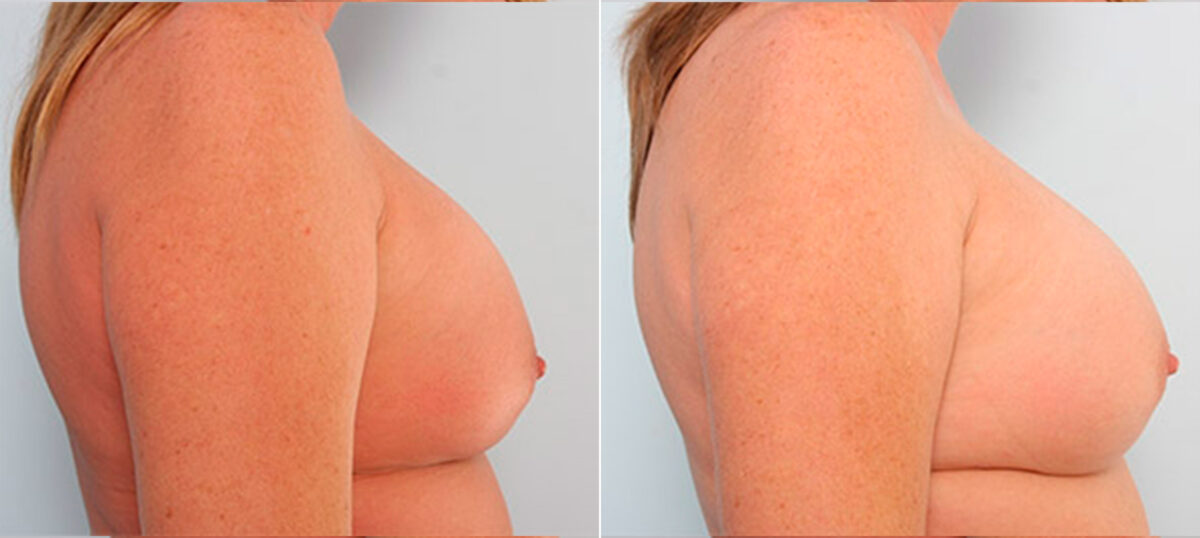 Breast Revision with Strattice before and after photos in Houston, TX, Patient 27279
