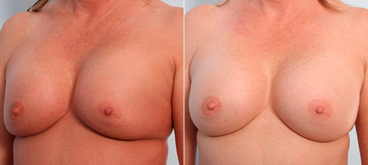Breast Revision with Strattice before and after photos in Houston, TX, Patient 27279