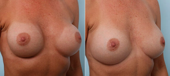 Breast Revision with Strattice before and after photos in Houston, TX, Patient 27312