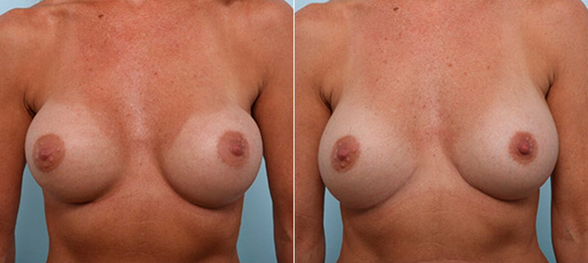 Breast Revision with Strattice before and after photos in Houston, TX, Patient 27312
