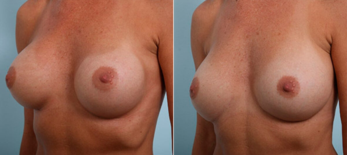 Breast Revision with Strattice before and after photos in Houston, TX, Patient 27312