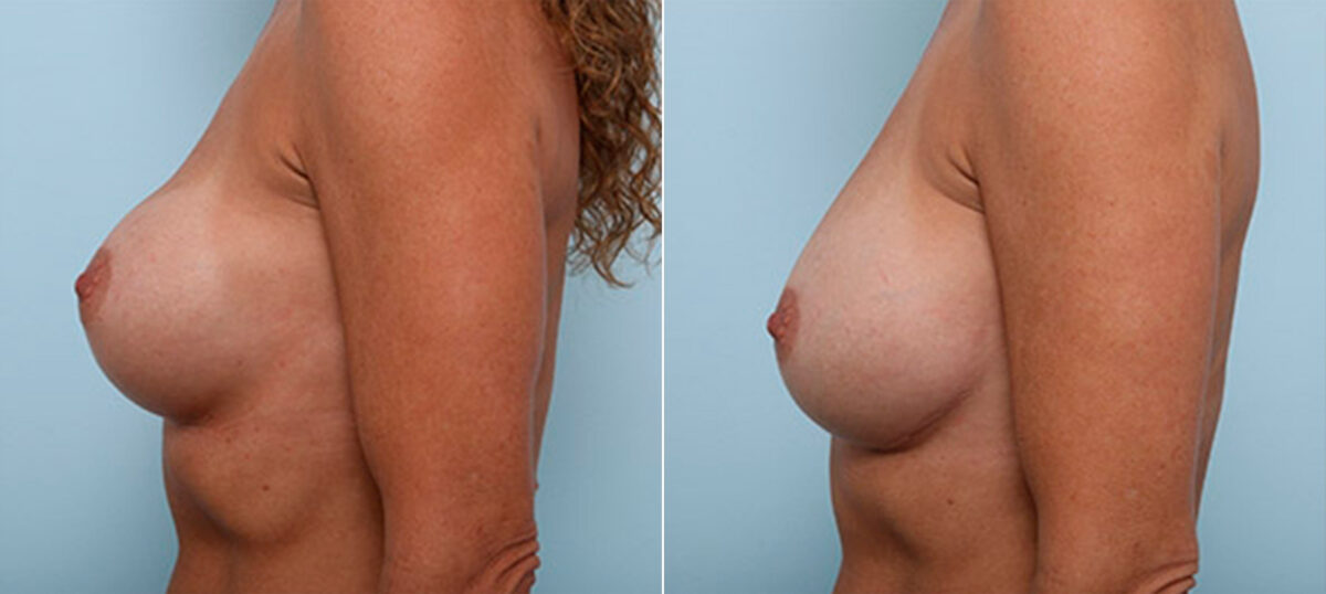 Breast Revision with Strattice before and after photos in Houston, TX, Patient 27312