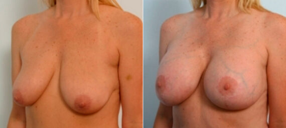 Breast Augmentation-Mastopexy before and after photos in Houston, TX, Patient 27323
