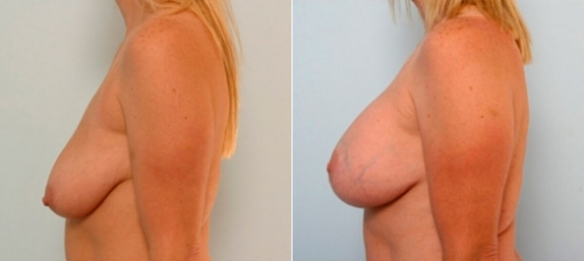 Breast Augmentation-Mastopexy before and after photos in Houston, TX, Patient 27323