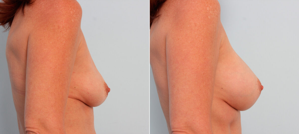 Breast Implant Exchange before and after photos in Houston, TX, Patient 27380