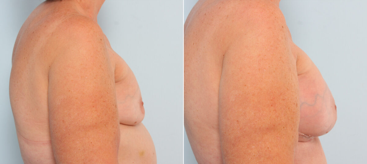 Breast Implant Exchange before and after photos in Houston, TX, Patient 27386