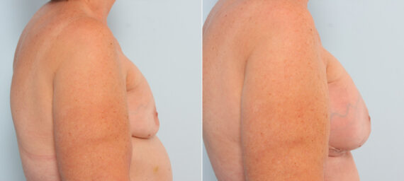 Breast Implant Exchange before and after photos in Houston, TX, Patient 27386