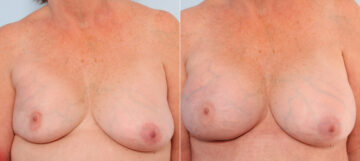 Breast Implant Exchange before and after photos in Houston, TX, Patient 27386
