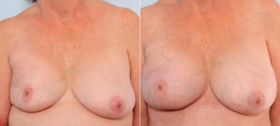 Breast Implant Exchange before and after photos in Houston, TX, Patient 27386