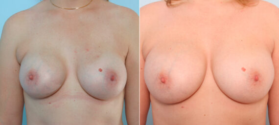 Breast Implant Exchange before and after photos in Houston, TX, Patient 27395