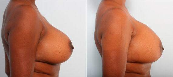 Breast Implant Exchange before and after photos in Houston, TX, Patient 27410