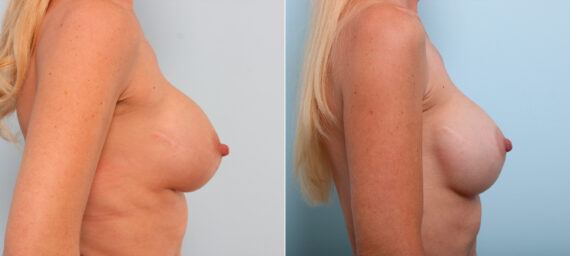 Breast Implant Exchange before and after photos in Houston, TX, Patient 27416