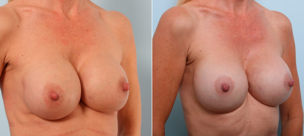 Breast Implant Exchange before and after photos in Houston, TX, Patient 27416