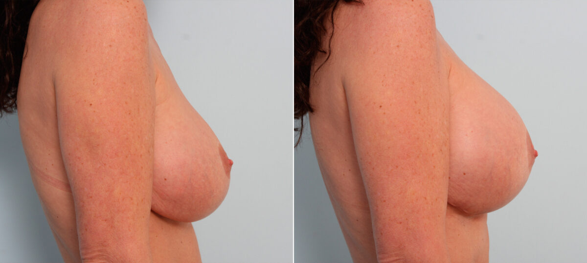 Breast Implant Exchange before and after photos in Houston, TX, Patient 27419