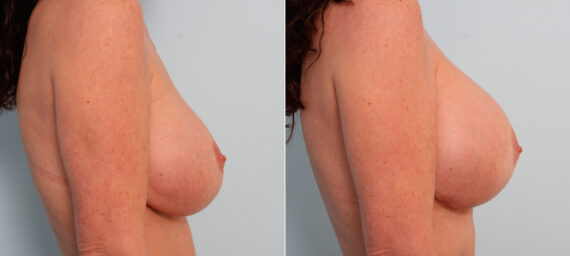 Breast Implant Exchange before and after photos in Houston, TX, Patient 27419