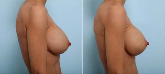 Breast Implant Exchange before and after photos in Houston, TX, Patient 27425
