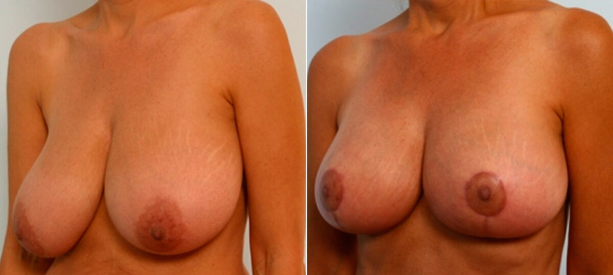 Breast Lift before and after photos in Houston, TX, Patient 27431