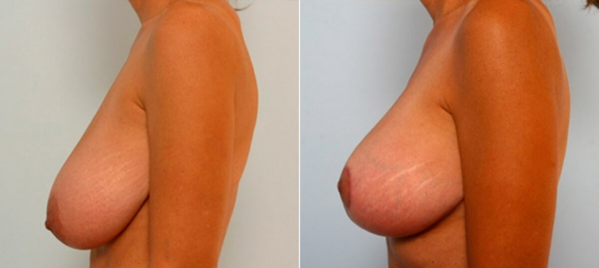 Breast Lift before and after photos in Houston, TX, Patient 27431