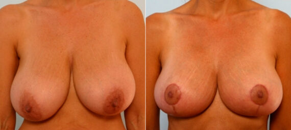 Breast Lift before and after photos in Houston, TX, Patient 27431