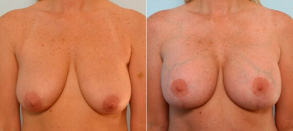 Breast Lift with Augmentation before and after photos in Houston, TX, Patient 27462