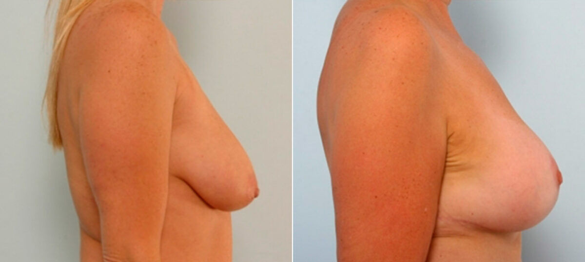 Breast Lift with Augmentation before and after photos in Houston, TX, Patient 27478