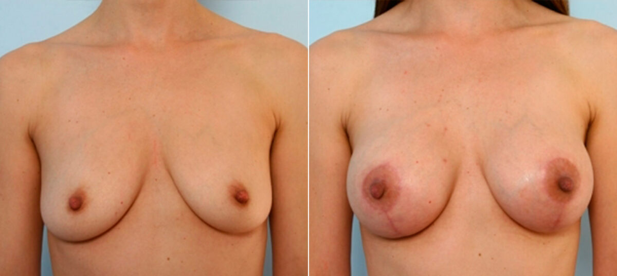 Breast Lift with Augmentation before and after photos in Houston, TX, Patient 27485