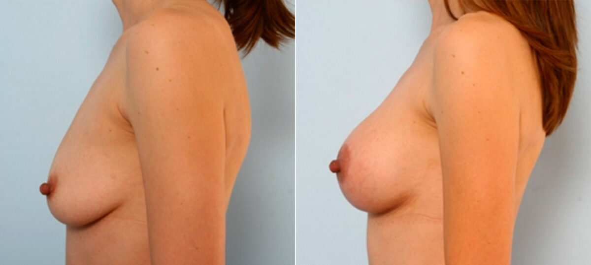 Breast Lift with Augmentation before and after photos in Houston, TX, Patient 27485