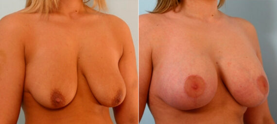 Breast Lift with Augmentation before and after photos in Houston, TX, Patient 27507