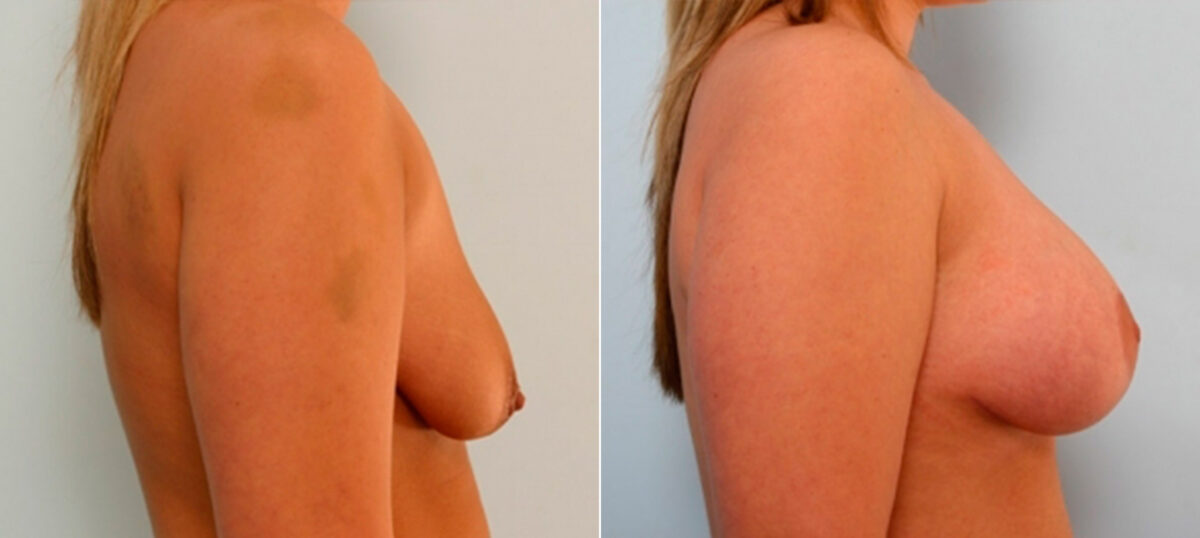 Breast Lift with Augmentation before and after photos in Houston, TX, Patient 27507