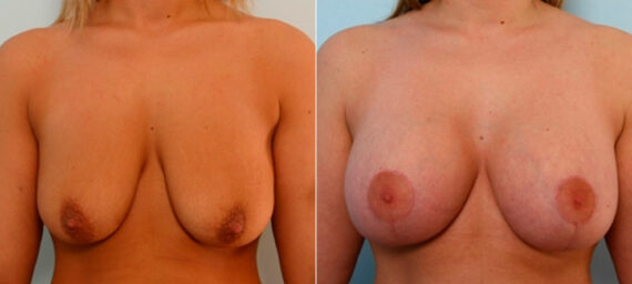 Breast Lift with Augmentation before and after photos in Houston, TX, Patient 27507